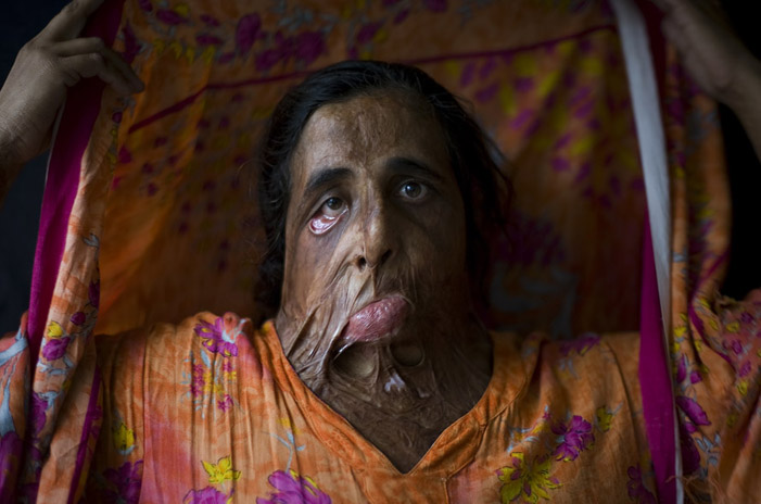 Shahnaz Bibi attacked with acid